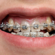 Illustration for article titled Southeast Asian Teenagers Are Obsessed with Fake Fashion Braces